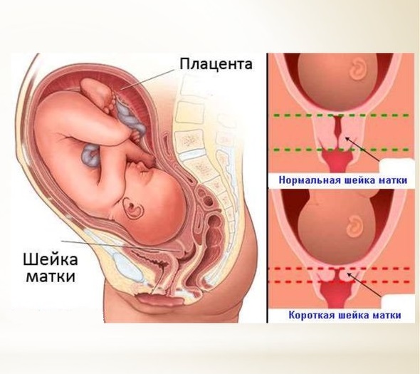 Профилактика ИЦН при беременности - клинические рекомендации